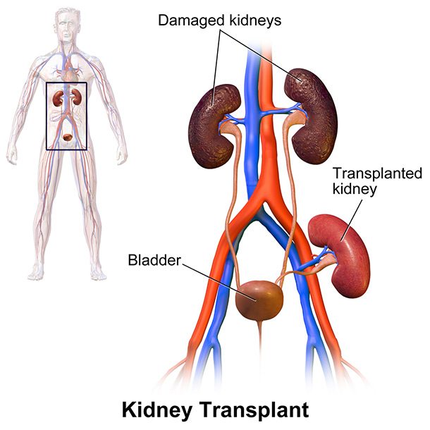 Kidney_Transplant