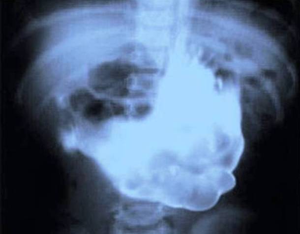 Cobblestone X-Ray