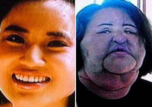 Plastic surgery gone wrong before and after picture female