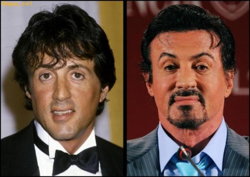 Sylvester Stallone's plastic surgery results