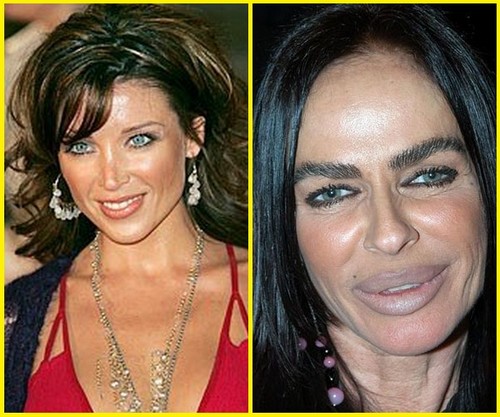 8 michaela-romanini-plastic-surgery-before-and-after_tn