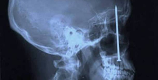 X-ray of a skull