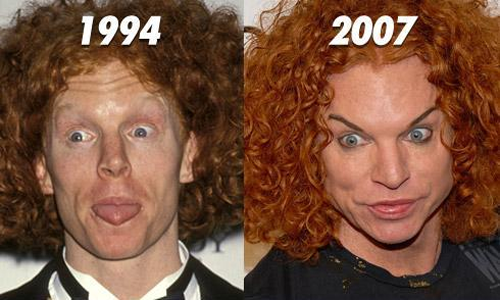 Carrot Top before and after plastic surgery results