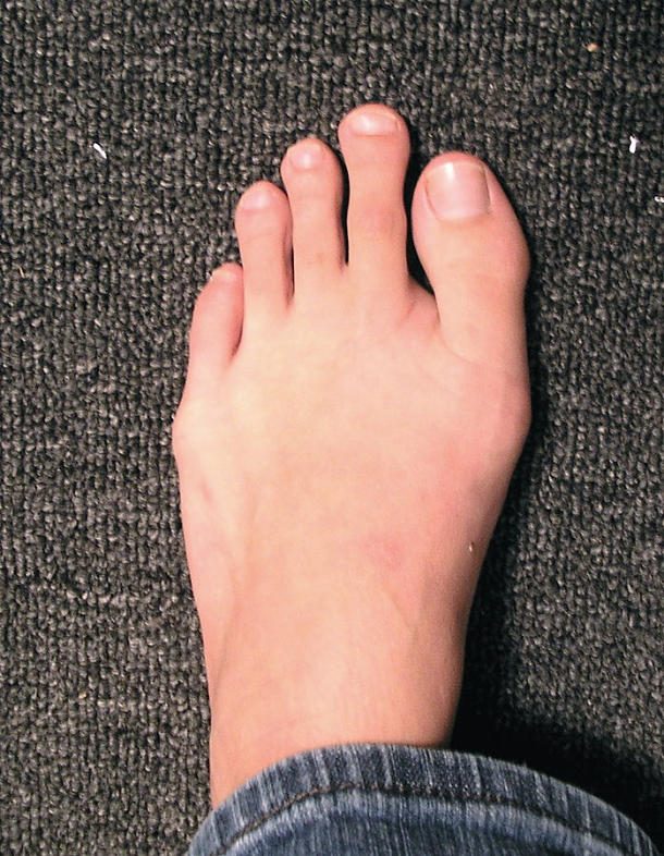 morton's toe