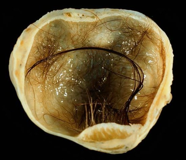 en.wikipedia.org Mature_cystic_teratoma_of_ovary