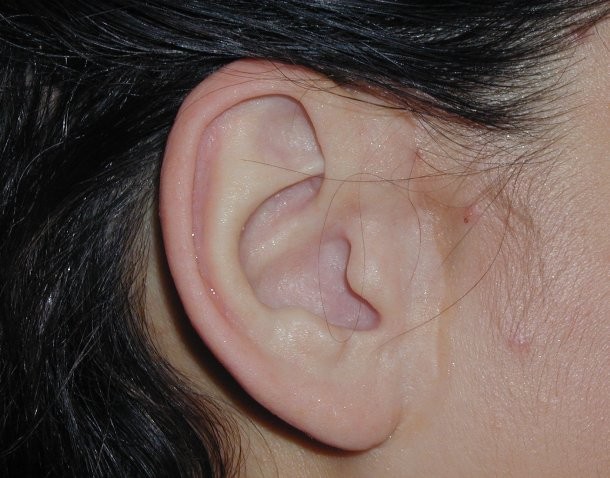 earcommunity.com 1600 × 1200 Option-3-Prosthetic-ear-attached-by-magnet-components