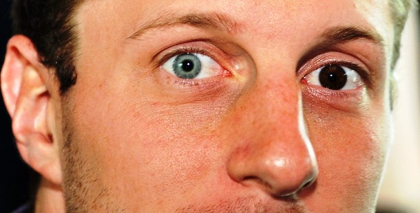 A close-up of a person's face with different colored eyes