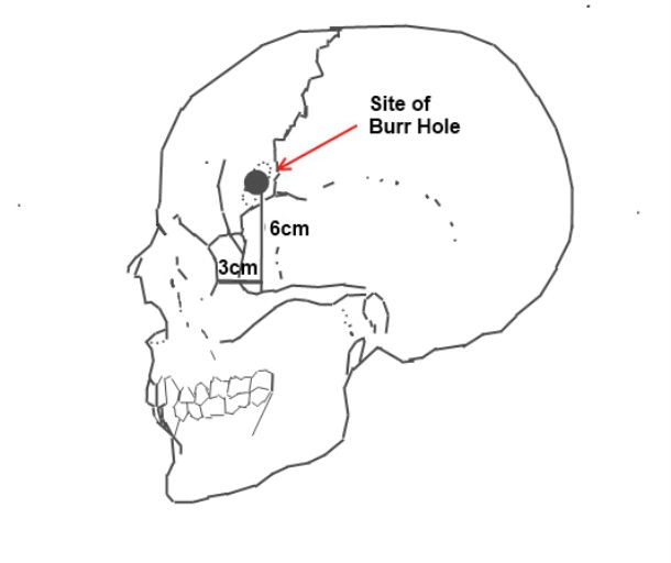 prefrontal lobotomy