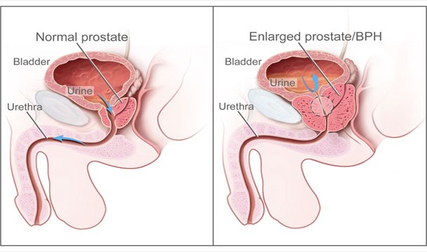 Hyperplasia of prostate