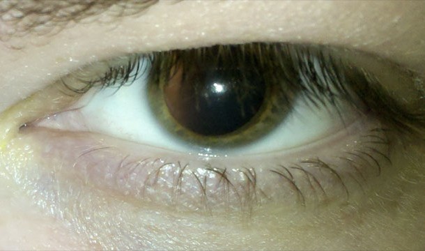 Dilated pupil