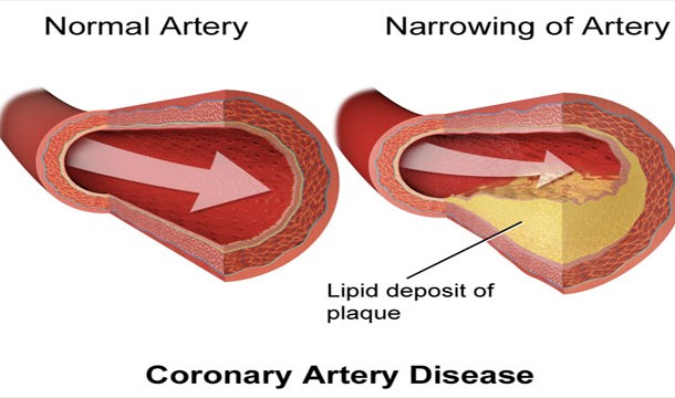 Atherosclerotic cardiovascular disease