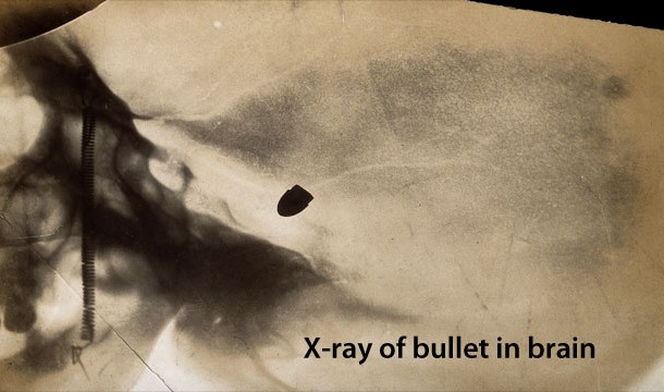 bullet in brain