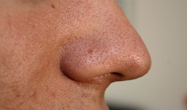 Your nose runs when its cold because the vessels in your nose receive more blood to keep it warm