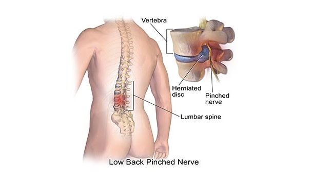 If you are experiencing lower back pain from standing too long then squeezing your butt muscles can make it go away. This is because it rotates your pelvis out of the painful position (too much anterior tilt) and flattens your back