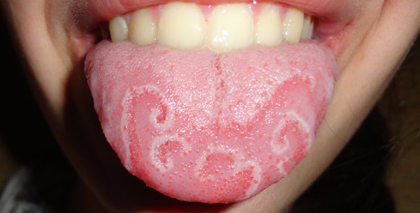 Geometric tongue