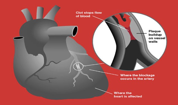 During heart attacks, males experience the "classic" symptoms like chest and jaw pain while for females the symptoms can be quite diverse. In fact, it can often be confused for heart burn.