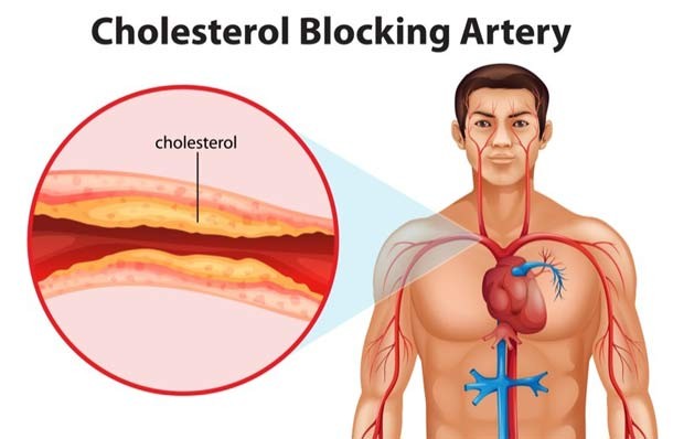 Cholesterol2