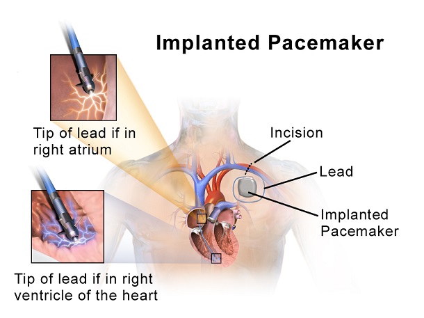 Pacemaker Placement