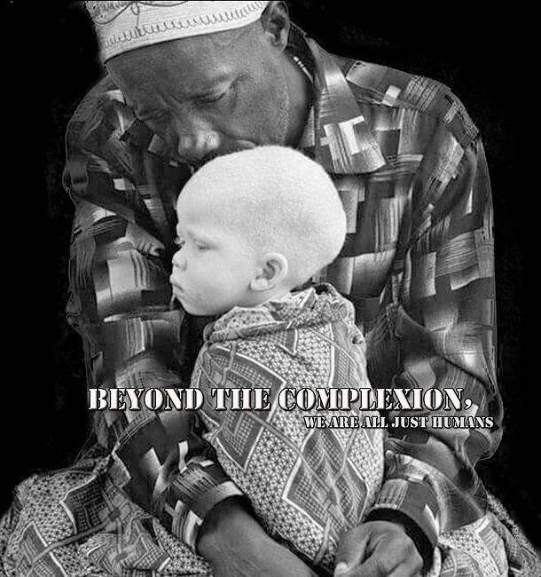 beyond the complexion albinism poster