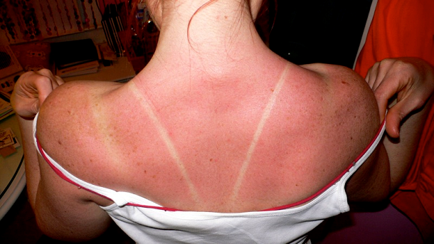 sunburn on back