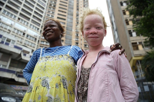two girls - one with albinism