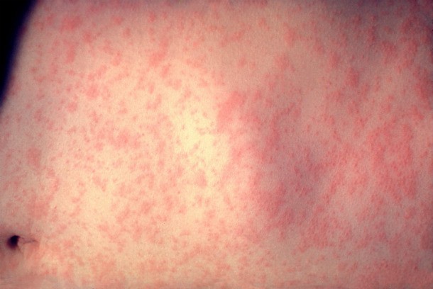 morbillivirus_measles_infection