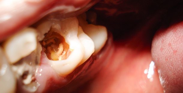 tooth with worms