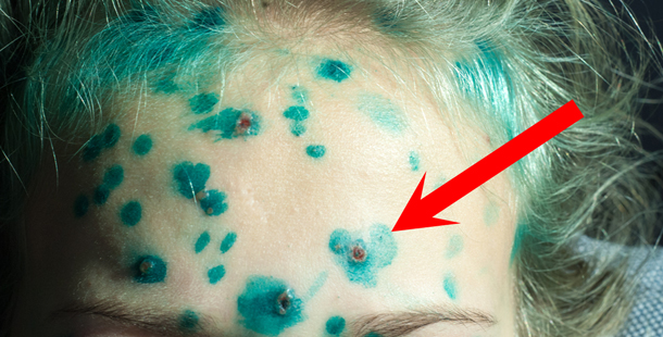 25 Illnesses And Diseases That Aren't As Deadly As They Used To Be