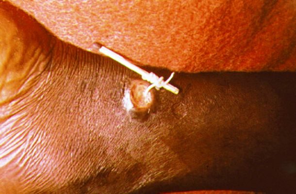 guinea worm
