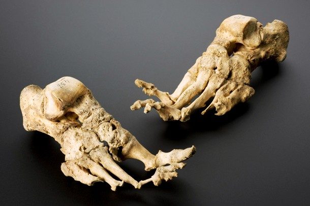 Skeleton showing effects of leprosy