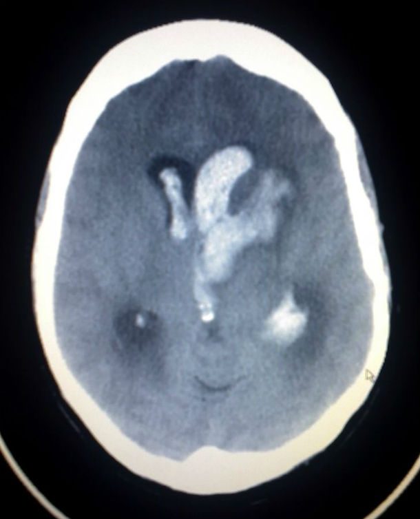Intracerebral_hemorrage_(CT_scan)