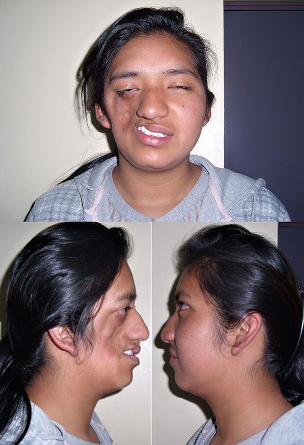 Parry_Romberg_Syndrome