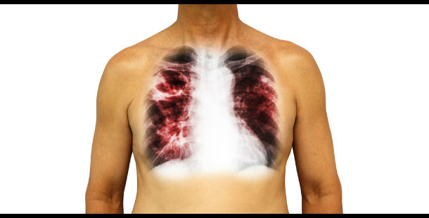 25 Little-Known Tuberculosis Facts You'll Want To Know