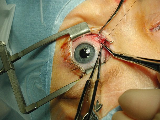 tooth in eye