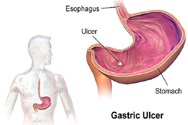 Gastric_Ulcer