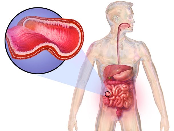 Crohn's_Disease