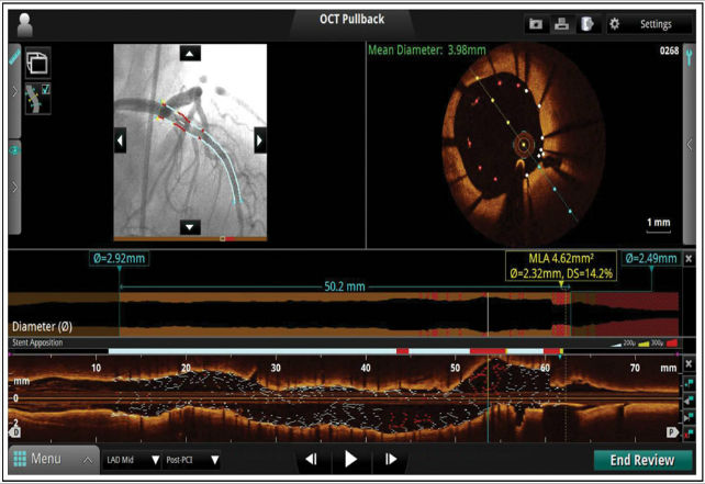 OCT-Atlas-OPTIS-imaging-software