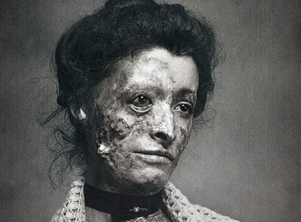 Victorian Woman With Syphilis